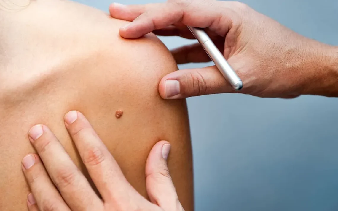 vacina contra melanoma;