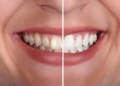 dentes, amarelados, manchas, sorriso, branco;